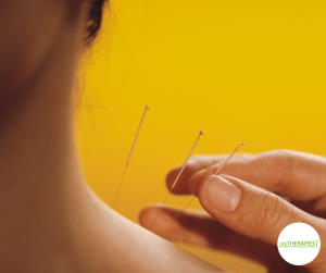woman receiving acupuncture